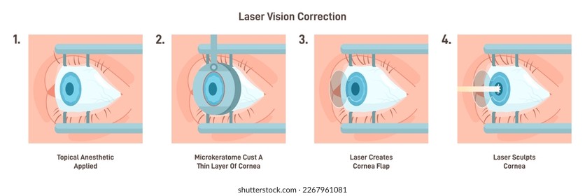 cirugía ocular LASIK. Paciente que recibe corrección óptica con un láser. El oftalmólogo realiza el tratamiento médico para mejorar la visión del paciente. Ilustración vectorial plana