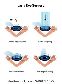 Lasik eye surgery steps procedure 