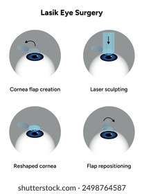 Lasik eye surgery steps procedure 