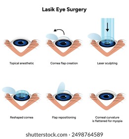 Lasik eye surgery steps procedure 