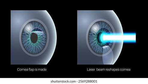 LASIK laser eye surgery 3D poster. Correction of vision issues nearsightedness, farsightedness, astigmatism. Safe painless procedure, reshapes cornea, human eye anatomical vector medical illustration