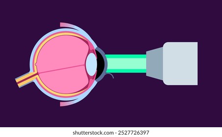 LASIK laser eye surgery. Correction of vision issues like nearsightedness, farsightedness, and astigmatism. Safe painless procedure reshapes the cornea, human eye anatomical flat vector illustration