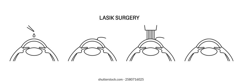 LASIK laser eye surgery. Correction of vision issues nearsightedness, farsightedness, and astigmatism. Safe painless procedure reshapes the cornea, human eye anatomical outline vector illustration