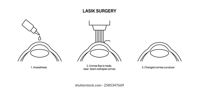 LASIK laser eye surgery. Correction of vision issues nearsightedness, farsightedness, and astigmatism. Safe painless procedure reshapes the cornea, human eye anatomical outline vector illustration