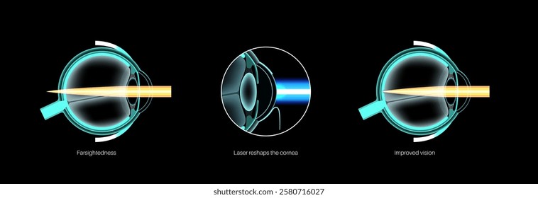 LASIK laser eye surgery, hyperopia. Correction of farsightedness, blurred vision issue treatment. Safe and painless procedure, reshapes the cornea process. Human eye anatomical vector illustration