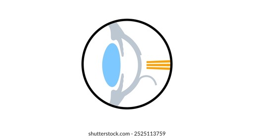 LASIK ícone de cirurgia ocular a laser. Correção de problemas de visão miopia, hipermetropia e astigmatismo. Procedimento seguro indolor remodela a córnea, olho humano ilustração de vetor plano anatômico