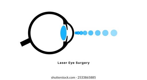 LASIK Laser Augenchirurgie Symbol. Korrektur von Sehstörungen: Kurzsichtigkeit, Weitsichtigkeit und Astigmatismus. Sicheres schmerzfreies Verfahren gestaltet die Hornhaut um, menschliches Auge anatomisch flache Vektorgrafik