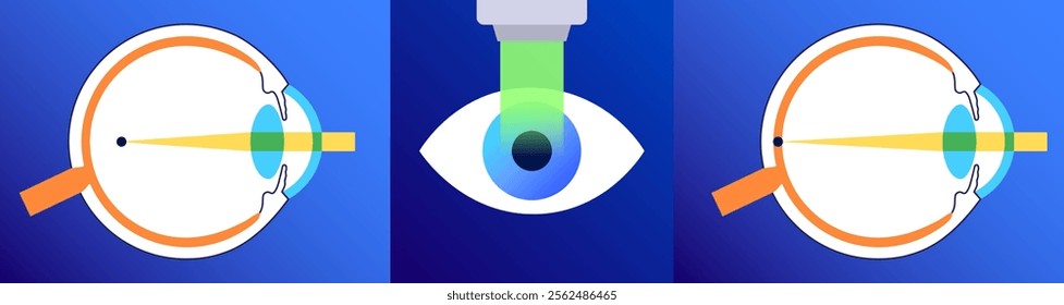 LASIK laser eye surgery infographic. Correction of vision issues nearsightedness, farsightedness, astigmatism. Safe painless procedure reshapes cornea, human eye anatomical flat vector illustration