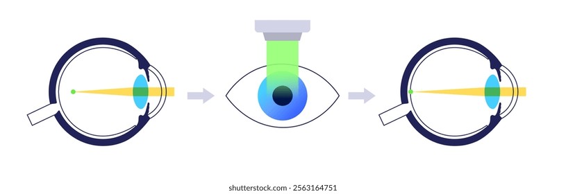 LASIK laser eye surgery infographic. Correction of vision issues nearsightedness, farsightedness, astigmatism. Safe painless procedure reshapes cornea, human eye anatomical flat vector illustration