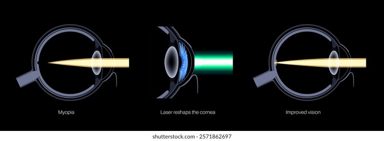 LASIK laser eye surgery, nearsightedness poster. Correction of myopia, blurred vision issue concept. Safe and painless procedure, reshapes the cornea process. Human eye anatomical vector illustration