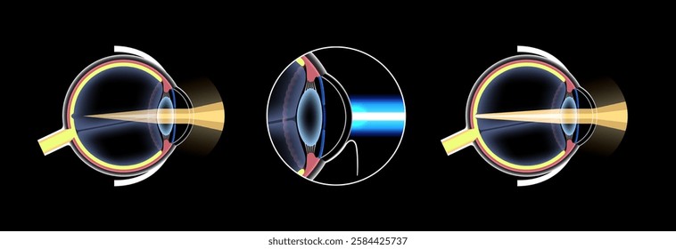 LASIK laser eye surgery, nearsightedness poster. Correction of myopia, blurred vision issue concept. Safe and painless procedure, reshapes the cornea process. Human eye anatomical vector illustration