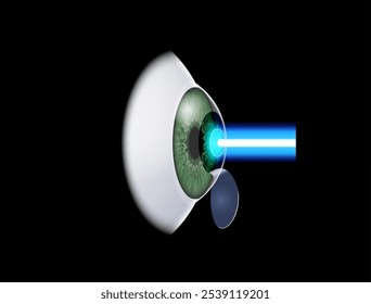 Cartaz de cirurgia ocular a laser LASIK. Correção de problemas de visão miopia, hipermetropia, astigmatismo. Procedimento seguro indolor, remodela a córnea, olho humano anatômico vetor 3D ilustração médica