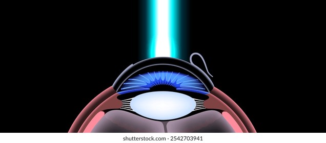 Cartaz de cirurgia ocular a laser LASIK. Correção de problemas de visão miopia, hipermetropia, astigmatismo. Procedimento seguro indolor, remodela a córnea, olho humano anatômico vetor 3D ilustração médica