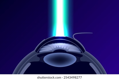 Cartaz de cirurgia ocular a laser LASIK. Correção de problemas de visão miopia, hipermetropia, astigmatismo. Procedimento seguro indolor, remodela a córnea, olho humano anatômico vetor 3D ilustração médica