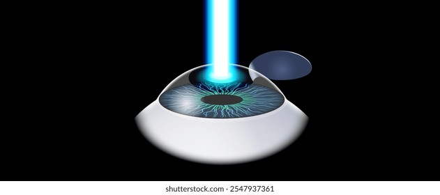 LASIK laser eye surgery poster. Correction of vision issues nearsightedness, farsightedness, astigmatism. Safe painless procedure, reshapes cornea, human eye anatomical 3D vector medical illustration