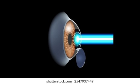 LASIK laser eye surgery poster. Correction of vision issues nearsightedness, farsightedness, astigmatism. Safe painless procedure, reshapes cornea, human eye anatomical 3D vector medical illustration