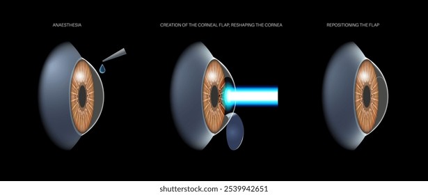 LASIK laser eye surgery process. Correction of vision issues nearsightedness, farsightedness, astigmatism. Safe painless procedure reshapes cornea human eye anatomical 3D realistic vector illustration