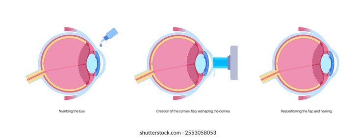 Proceso de cirugía ocular con láser LASIK. Corrección de problemas de visión miopía, hipermetropía, astigmatismo. Procedimiento seguro e indoloro remodela la córnea del ojo humano Ilustración vectorial anatómica plana