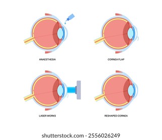 LASIK laser eye surgery process. Correction of vision issues nearsightedness, farsightedness, astigmatism. Safe painless procedure reshapes cornea human eye anatomical poster flat vector illustration