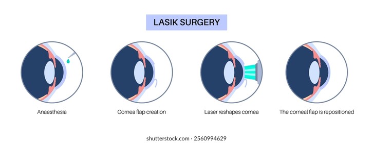LASIK laser eye surgery process. Correction of vision issues nearsightedness, farsightedness, astigmatism. Safe painless procedure reshapes cornea human eye anatomical poster flat vector illustration
