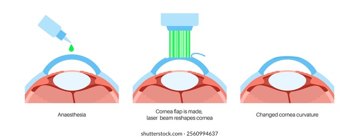 LASIK laser eye surgery process. Correction of vision issues nearsightedness, farsightedness, astigmatism. Safe painless procedure reshapes cornea human eye anatomical poster flat vector illustration