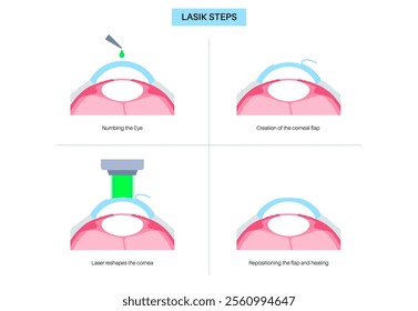 LASIK laser eye surgery process. Correction of vision issues nearsightedness, farsightedness, astigmatism. Safe painless procedure reshapes cornea human eye anatomical 3D realistic vector illustration