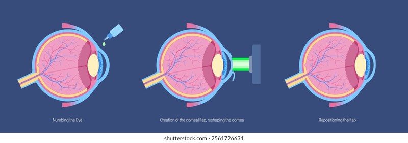 LASIK laser eye surgery process. Correction of vision issues nearsightedness, farsightedness, astigmatism. Safe painless procedure reshapes cornea human eye anatomical poster flat vector illustration