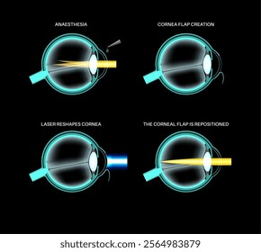 LASIK laser eye surgery process. Correction of vision issues nearsightedness, farsightedness, astigmatism. Safe painless procedure reshapes cornea human eye anatomical 3D realistic vector illustration