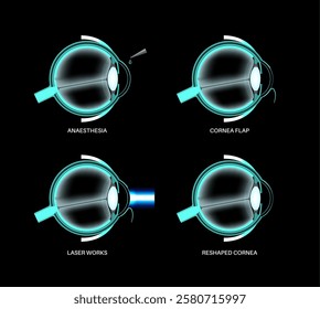 LASIK laser eye surgery process. Correction of vision issues nearsightedness, farsightedness, astigmatism. Safe painless procedure reshapes cornea human eye anatomical 3D realistic vector illustration