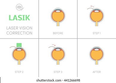 Lasik - laser vision correction concept. Steps of surgery, vector