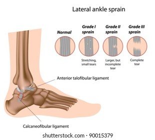 Lateral ankle sprains and grading