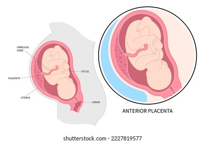 Anatomía placentaria anterior del bebé en el útero según la clasificación médica 