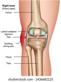 Lateral Collateral Tear 3d Medical Vector Infographic Isolated On White Background