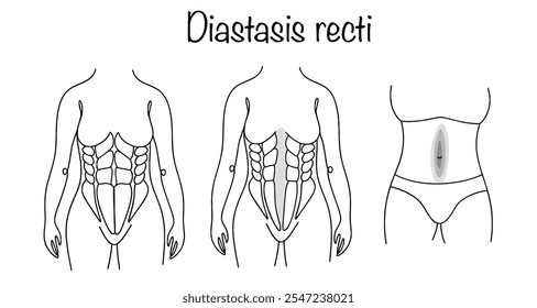 Divergência lateral dos músculos do reto abdominal ao longo da linea alba. Desenho de uma mulher com posição muscular correta e uma mulher com diástase retal. Uma patologia que geralmente ocorre após a gestação