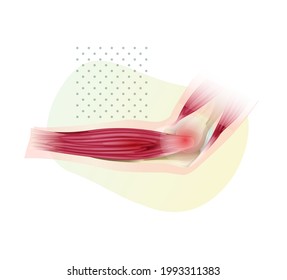 Lateral Epicondylitis known as Tennis Elbow - Stock Illustration as EPS 10 File