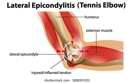 Lateral Epicondylitis or tennis elbow illustration