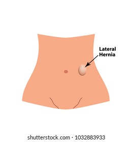 Lateral Herniation. intestinal hernia. Infographics. Vector illustration on isolated background.