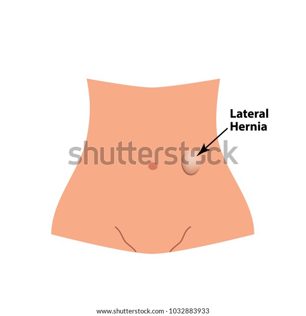 Lateral Herniation Intestinal Hernia Infographics Vector Vetor Stock