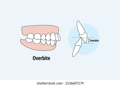 Lateral Overbite. Dental problem vector illustration. Dental care concept.