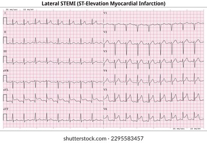 Lateral ST-Elevation Myocardial Infarction (STEMI) - 12 Lead ECG Common Case - 6 Sec - Vectors and Illustration for Medical Purposes