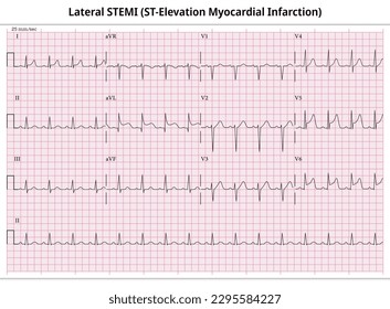 Lateral ST-Elevation Myocardial Infarction (STEMI) - 12 Lead ECG Common Case - 3 Sec - Vectors and Illustration for Medical Purposes