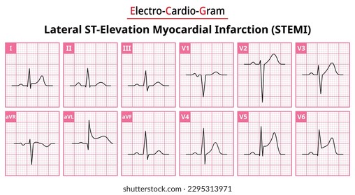 Lateral STEMI (ST-Elevation Myocardial Infarction) - The Differences in ECG Waveform for Each of the 12 Leads - Vectors and Illustrations for Medical Purposes