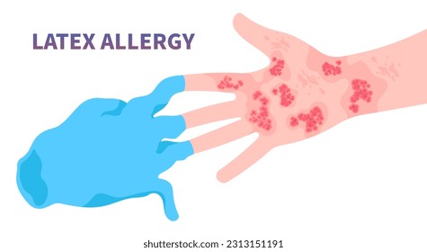 latex allergy the allergic itching around finger arm wrist health care and wear gloves natural pain skin rash and Hives dermatitis with tree dry chemical exposure infection