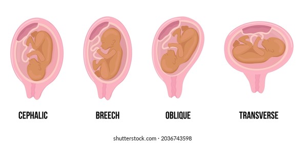 Latin Arabian brown skin baby. Different wrong baby positions in uterus during pregnancy. Cephalic, Breech, transverse, Oblique lies. Colored medical vector. Fetus with umbilical cord and placenta