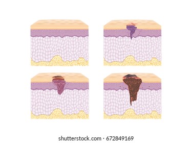 Layer of normal Skin and Spreading of Cancer Cell in vector style in collection. Illustration about medical and health.