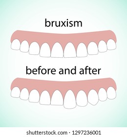 Layout attrition Bruxism teeth illustration vector. Erased teeth. Restoration of teeth. Dental concept