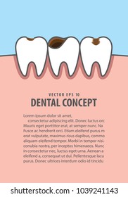 Layout Caries and cavity teeth illustration vector on blue background. Dental concept.