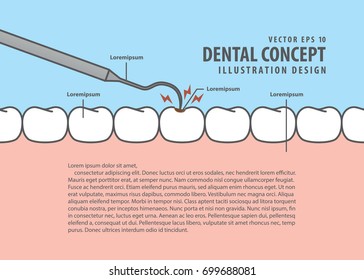 Layout decay tooth check up (Caries) cartoon style for info or book illustration vector. Dental concept.