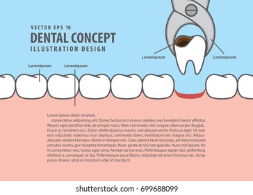 Layout decay tooth removal cartoon style for info or book illustration vector. Dental concept.