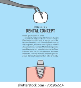 Layout Implant cartoon style for info or book illustration vector on blue background. Dental concept.